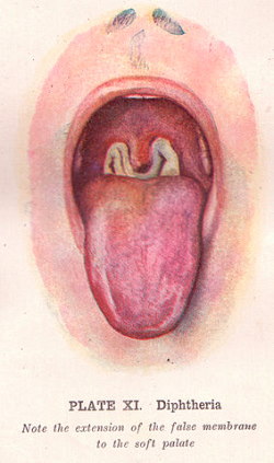 An illustration of the tonsillar pseudomembrane in diphtheria.